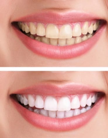 Blanqueamiento Dental