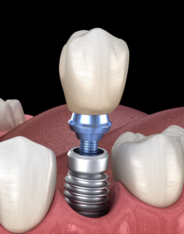 Implantes Dentales
